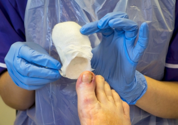 หลังการผ่าตัดแพทย์จะส่งคุณกลับบ้านพร้อมกับพันนิ้วเท้า