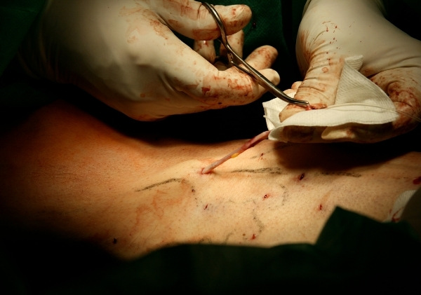 การผ่าตัดและการลอกเส้นเลือดเป็นการผ่าตัดที่ต้องดมยาสลบ
